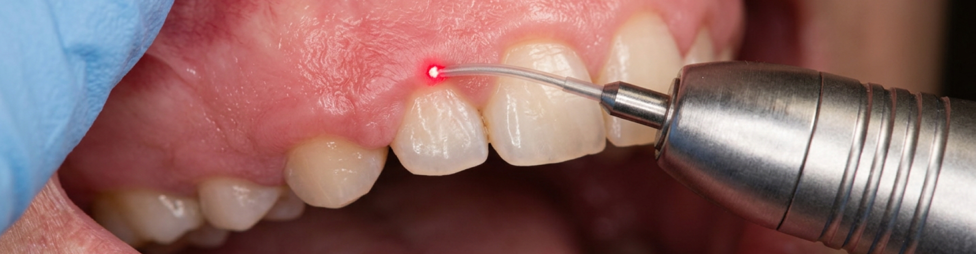 Gum contouring treatment using a dental laser to reshape excess gum tissue around the front teeth.